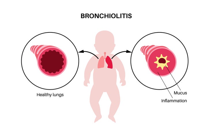 bronchiolitis graphic