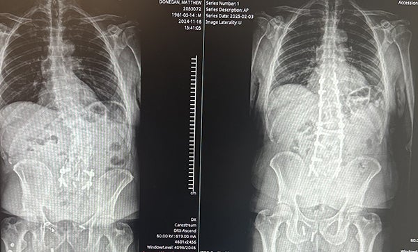 Spine x-ray